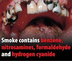 An example of one of the new picture warnings on cigarette packets.