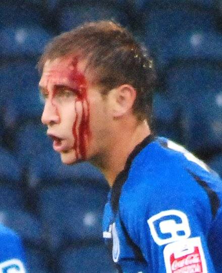 Dawson suffered a head injury midway through the first half.