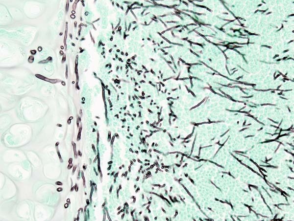 Pulmonary Aspergillosis