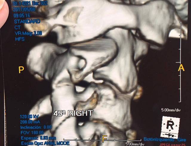 Scar tissue has formed and is pressing on her brainstem and due to the weakness of the ligaments in her neck, Sam is at high risk of internal decapitation