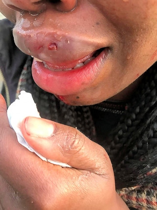 This young woman slipped and broke one of her front teeth