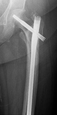 An x-ray showing the pin inserted into Lee's leg after surgery