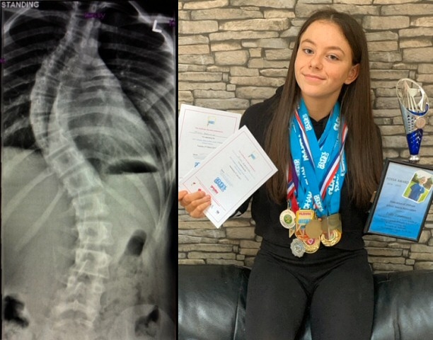 The X-ray shows Tilly's spine is of an 'S' shape