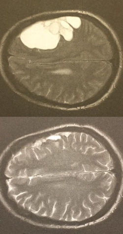 Top: a scan of the mass on Joanne’s brain, before the surgery Bottom: a scan of Joanne’s brain after the surgery