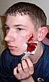 Scarred: The teenager, Stephan Coffey, suffered a gash to the side of his face.