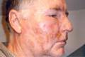 Neil Kelly suffered acid burns to his face, neck and arm at a house in Heywood