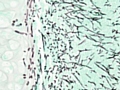 Pulmonary Aspergillosis