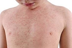 Child with measles