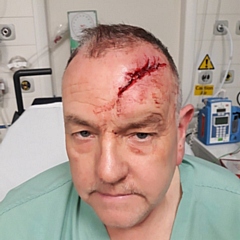 Paul Schofield was hit over the head with a baseball bat