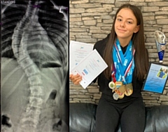 The X-ray shows Tilly's spine is of an 'S' shape