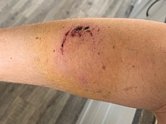 The bite injury suffered by the police officer