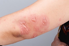 Shingles symptoms on someone's arm